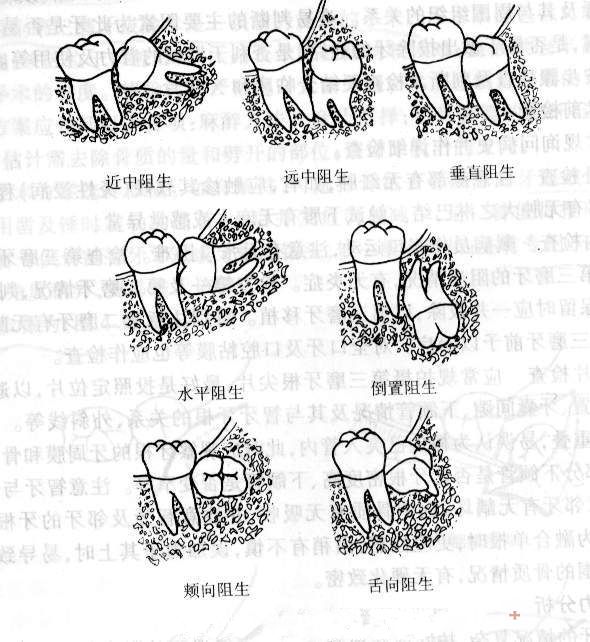 无痛治疗 智齿|尽头牙