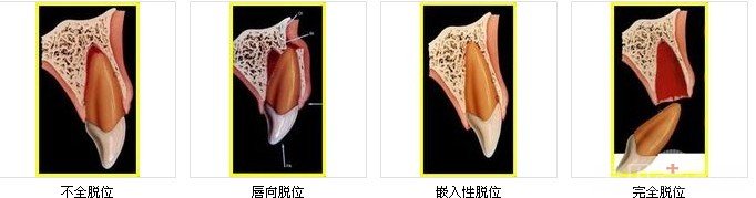 出现此情况是非常棘手的,及时就诊可以比较大程度的挽救自己的牙齿
