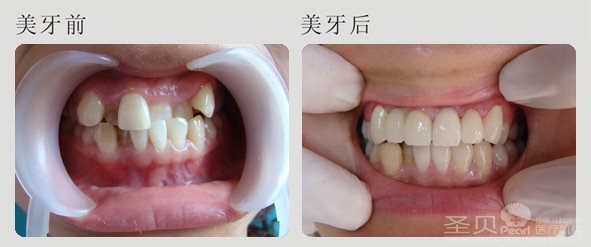 美容冠牙齿矫正的过程是什么