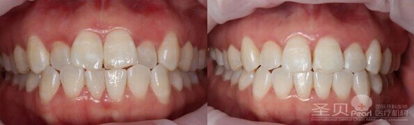 28岁牙齿矫正用什么方法效果比较好 