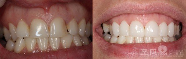 什么方法美白牙齿比较好