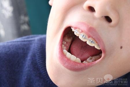 儿童牙齿矫正的价格