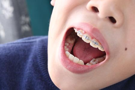 儿童牙齿矫正有伤害吗