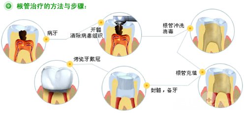 牙髓炎根管治疗好不好