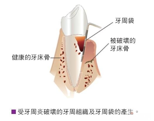 牙周炎怎么治