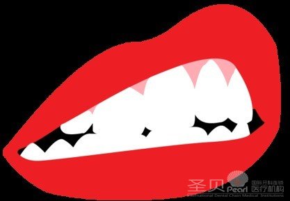 氟斑牙怎么美白