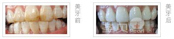 氟斑牙怎么治疗