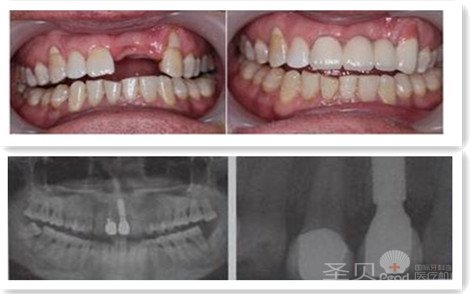 多颗牙缺失治疗前后对比