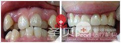 牙齿拥挤矫正案例