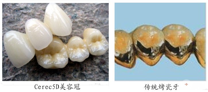 5D美容冠与烤瓷牙修复有什么区别