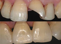 杨小姐牙冠折断修复案例