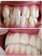 龚先生门牙畸形