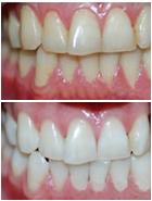 Prussian炫彩美白 治疗黄牙案例