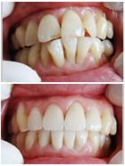 牙齿拥挤美容冠修复案例