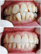 Prussian亲贝定制牙美容技术让您重拾笑容