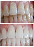 四环素牙的克星 cerec5D美牙无阻力