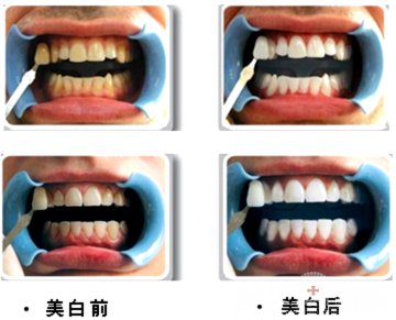 氟斑牙怎样美白