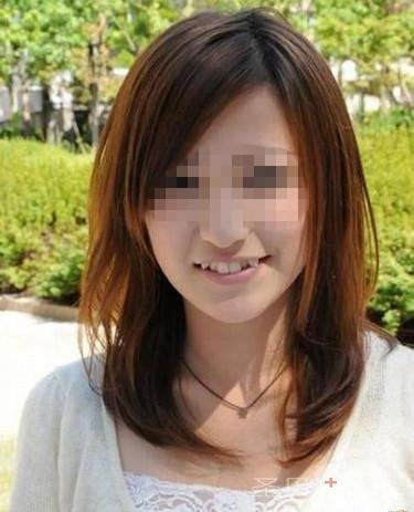 牙齿还能这样整 丑女一周变班花