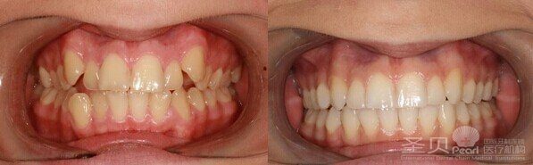做一颗全瓷牙价格是多少