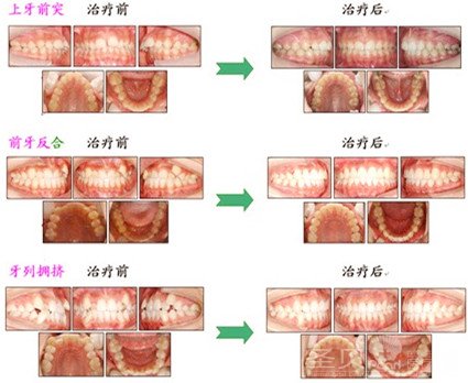 一般牙齿矫正有哪些步骤