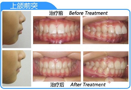美颜正畸 您真的了解清楚了吗