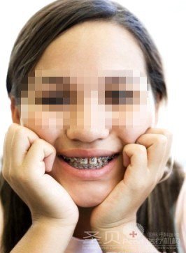 如何认清牙齿矫正的黄金期