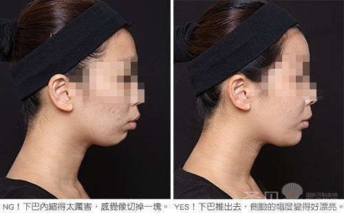西安龅牙矫正多少钱
