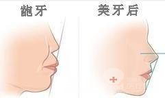 圣贝牙科Cerec5D美容冠怎么样