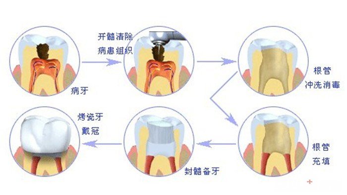 西安牙髓炎疼痛怎么办