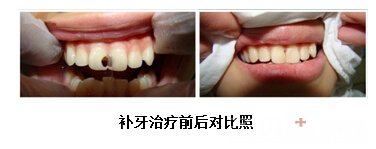 西安微痛补牙