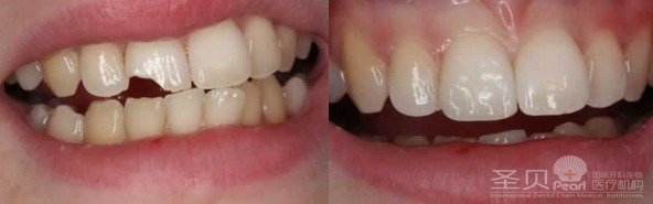 门牙磨损怎么治