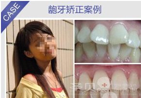 龅牙矫正要多久