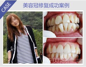 成人牙齿矫正成功案例