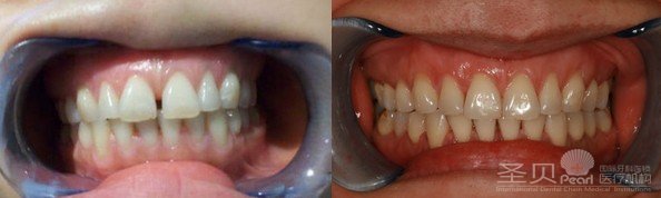 牙齿稀疏怎么办