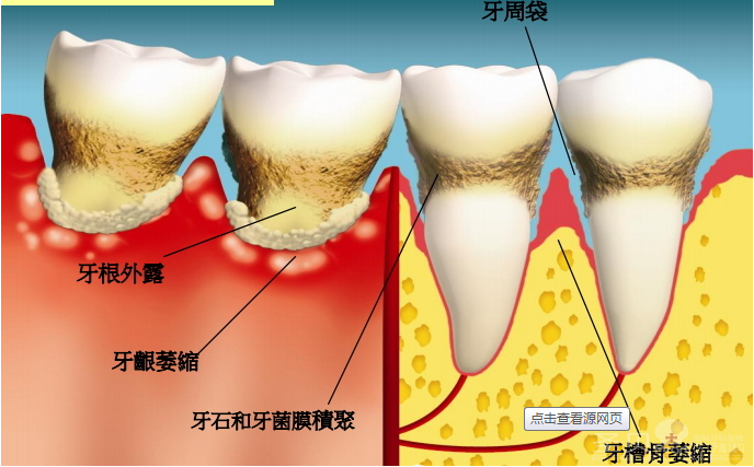 牙周炎的几种预警症状