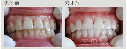 四环素牙引起的危害有哪些