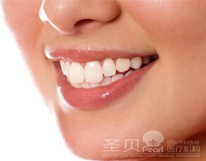 牙列稀疏的四种类型