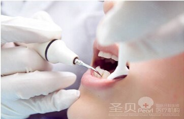 牙结石了 怎么办