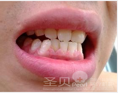 牙龈萎缩如何治疗