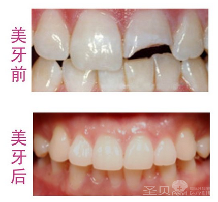全瓷牙的价格是多少
