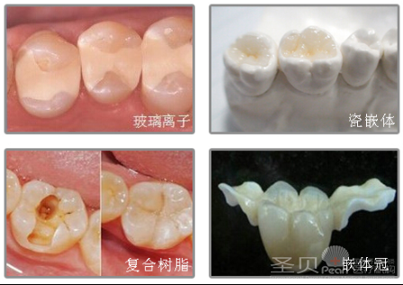 补牙的材料有哪些