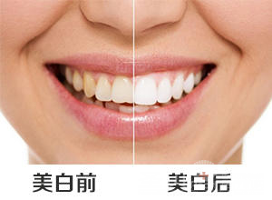 美白牙齿能有多久