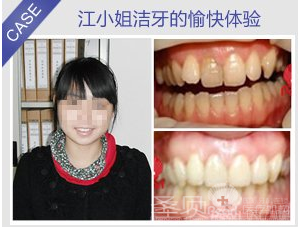 牙结石怎么祛除