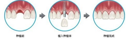 哪些患者可以种植牙