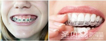 西安牙齿矫正哪家医院好