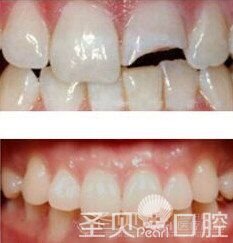 牙齿缺了一块能补吗