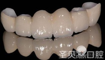 全瓷牙和烤瓷牙有什么区别