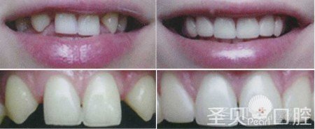 成都全瓷牙哪家口碑好